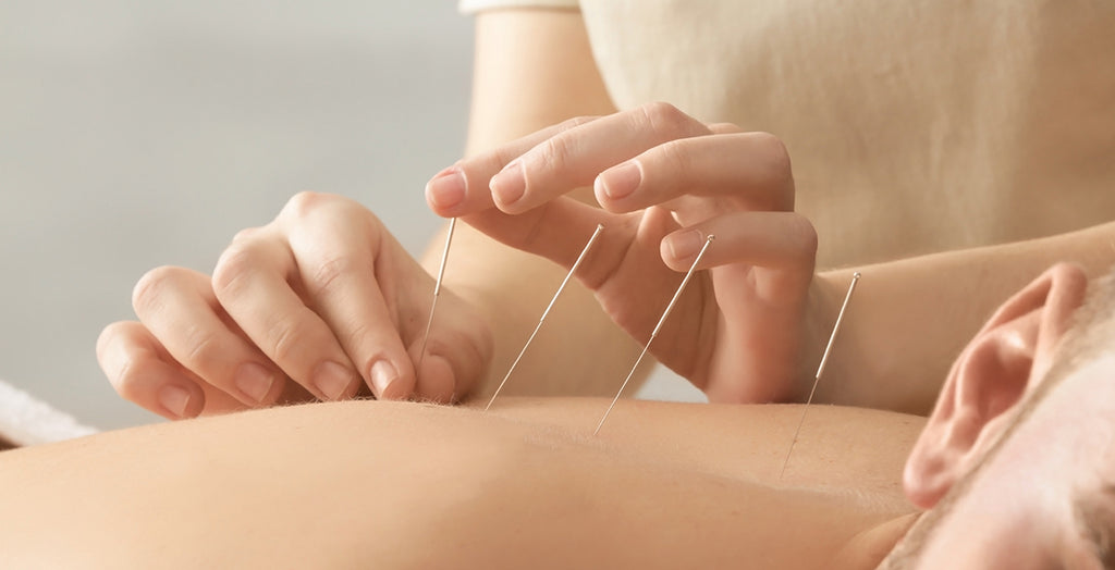 Acupuncture