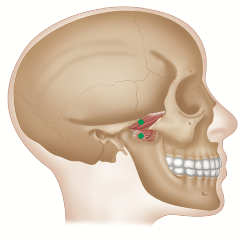 Lateral Pterygoid Trigger Point Release