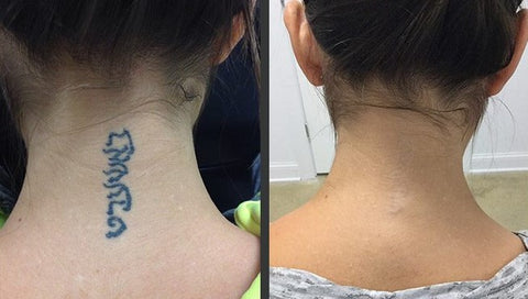 Chicagos Vamoose Tattoo Removal opens Gurnee location  Shaw Local
