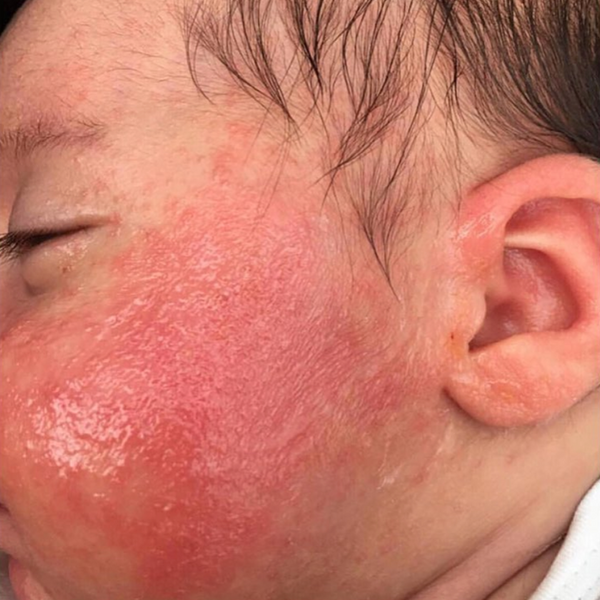An image of a baby with Atopic dermatitis (eczema).