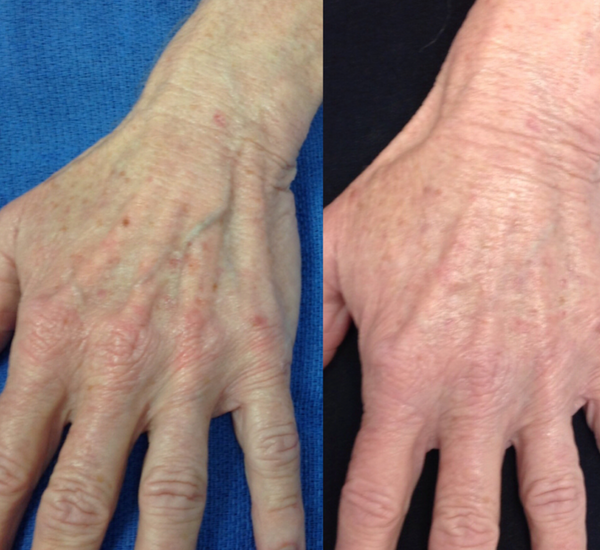 An image of a before and after of a Hand Rejuvenation treatment by Dr Heidi