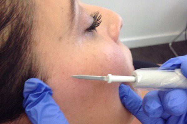 An image of dr. heidi performing a skin growth removal procedure.