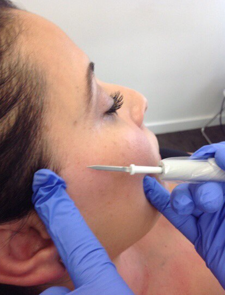 An image of Dr. Heidi performing a skin growth removal on a patients right cheek.