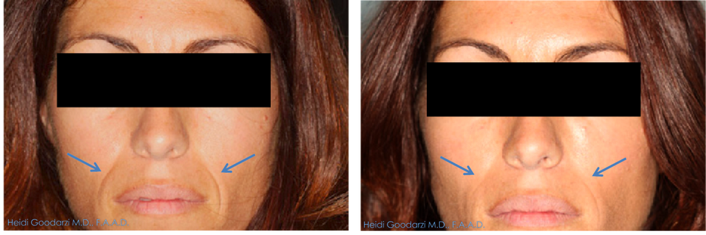 A image of a before and after laugh line filler procedure