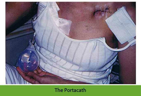 The Portacath