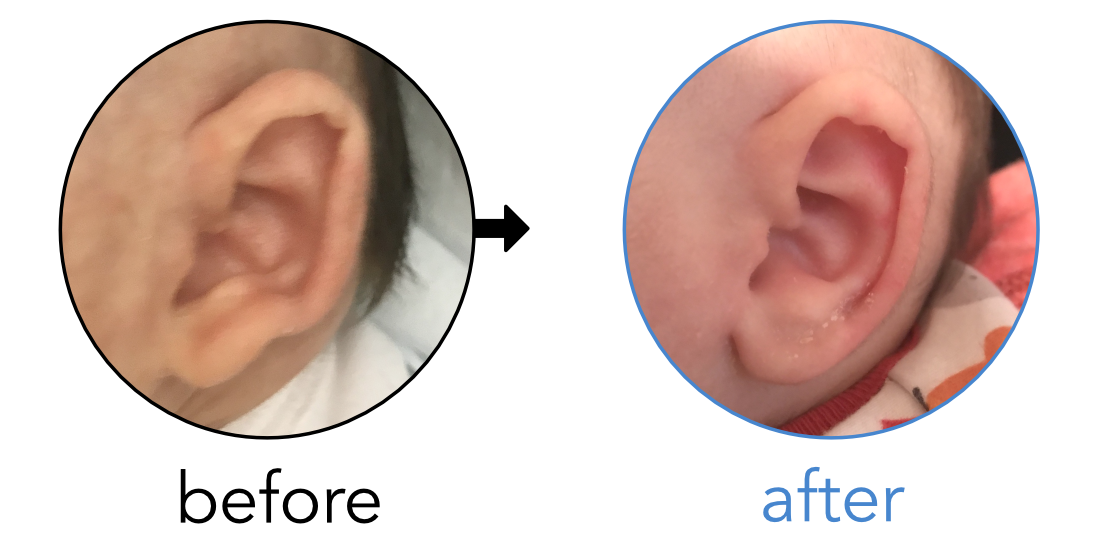 babys ear lobe crinkled