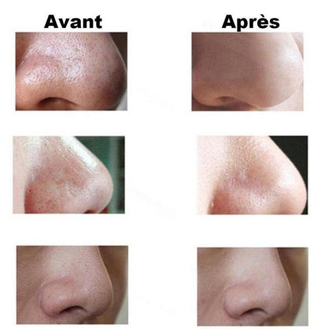 Aspirateur à points noirs VivaSkin™