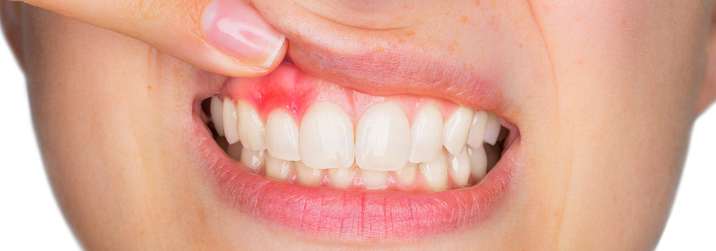 Parodontitis - Was tun bei Zahnfleischentzündung?