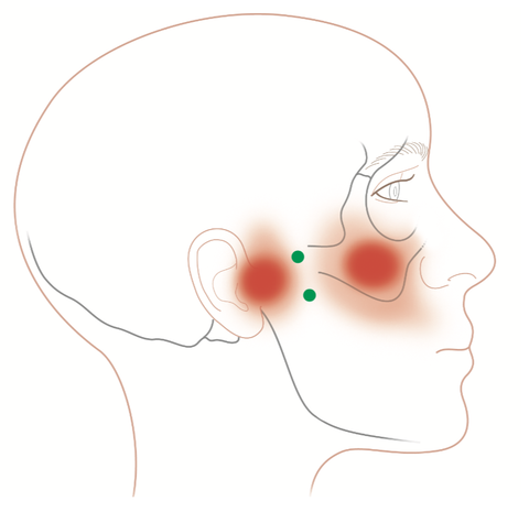 Lateral Pterygoid Trigger Points