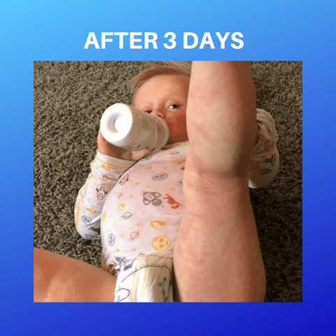 Atopic Dermatitis Rash After 3 days of Soothems Wet wrap