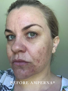 Acne Skin Care | RESULTS AMPERNA