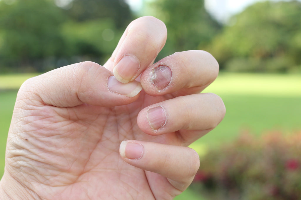 what-is-nail-psoriasis-nuvothera